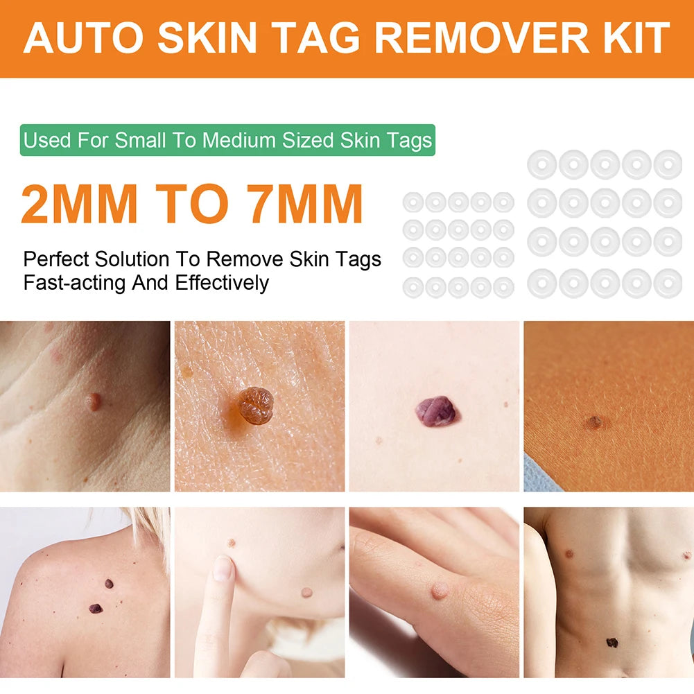 2-in-1 Skin Tag Removal Tool